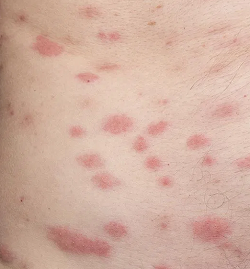 se debarrasser des boutons de punaise de lit