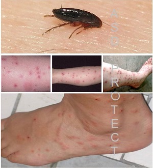 Lluvioso Albany Radioactivo Piqûre de puce : symptômes, photo, quels soins ?