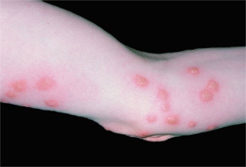 Piqûre de punaise de lit