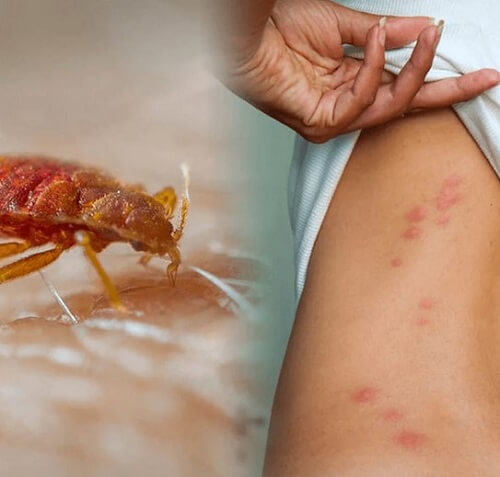 Piqure de punaise de lit