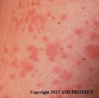 Boutons et piqûres punaises de lit